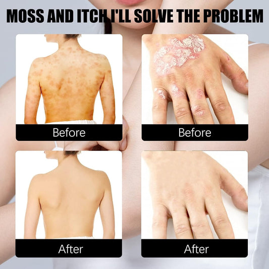 Herbal Psoriasis Relief Spray